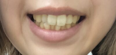 黄色い歯